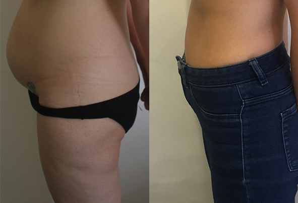 Abdominoplasty-Sydney